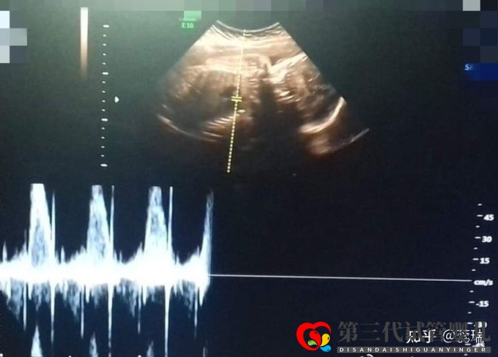 我终于怀上了!辛酸三代试管经历!大家接好孕!(图3) 我终于怀上了!辛酸三代试管经历!大家接好孕!(图3)