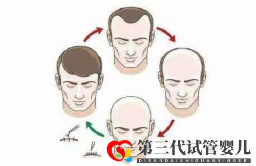 植发可以解决秃顶或头发稀少的问题吗?头发种植多久见效呢?(图1) 植发可以解决秃顶或头发稀少的问题吗?头发种植多久见效呢?(图1)