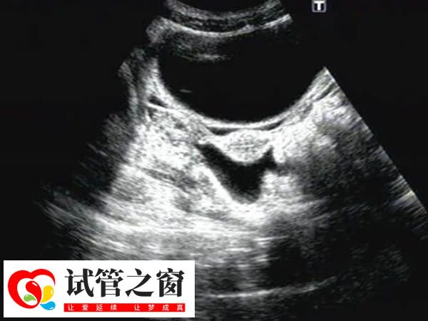 盆腔积液是女性生殖系统的常见症状表现