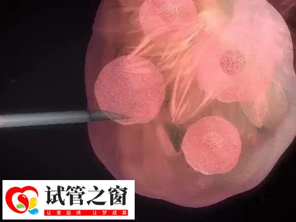 取卵前促排卵使用过多会增加患癌风险